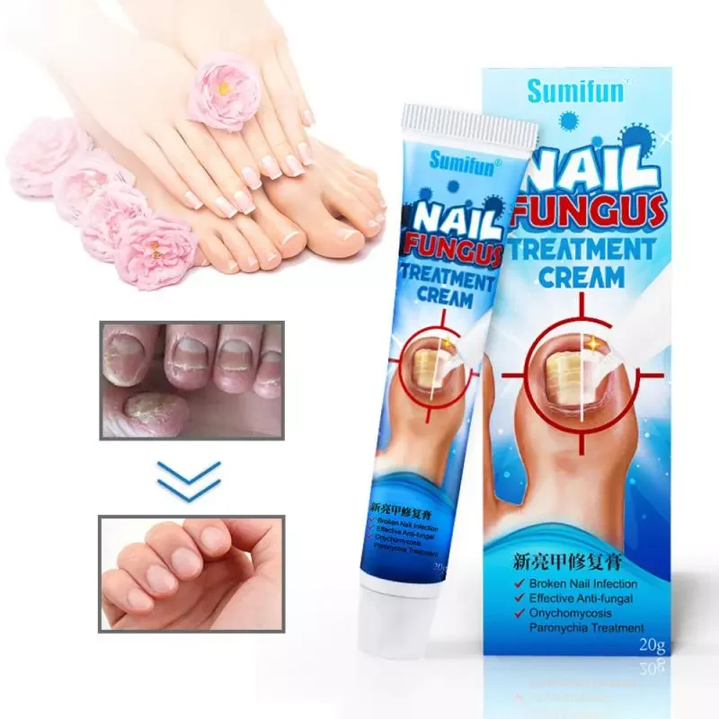 

Effective Nail Treatments Cream Nail Fungus Removal Cream Onychomycosis Paronychia Soft Nail Toenail Repair Ointment 20g