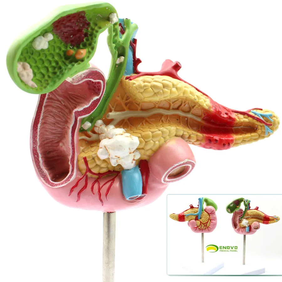 

Патологическая модель поджелудочной железы, Duodenum и желчного пузыря в еново, медицинская научная хирургическая модель пищеварительной системы