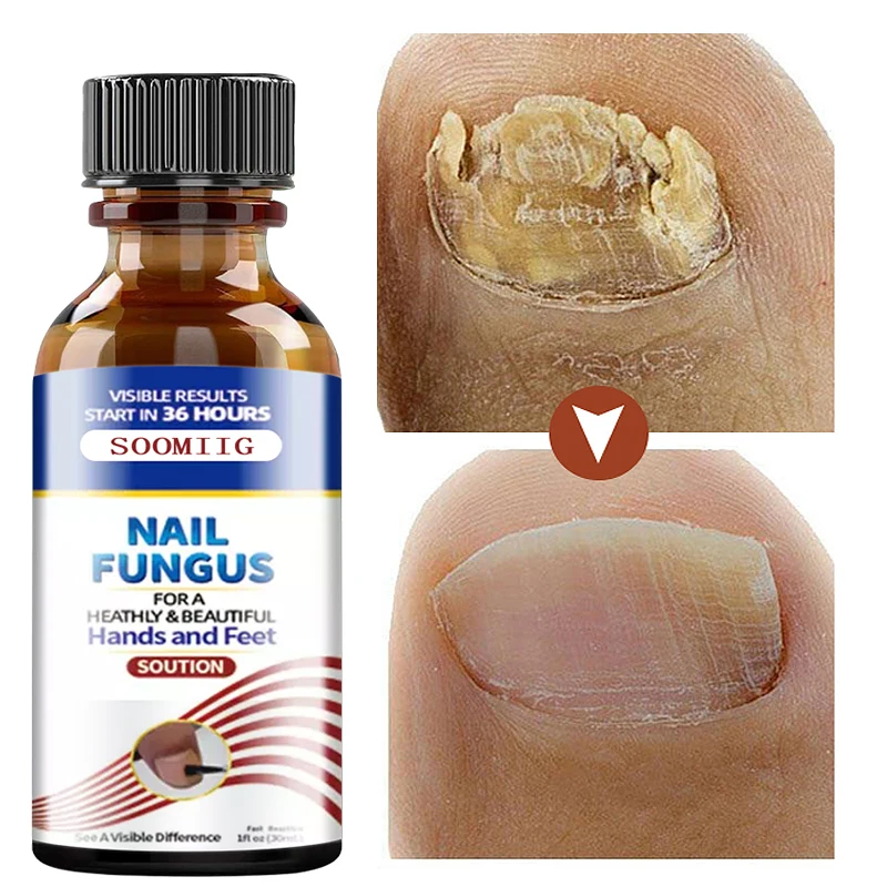 

Sdotter Nail Fungus Treatment Serum Hand & Foot Care Fungus Removal & Repair Gel Anti-Infection Parasitic Diseases Mycos