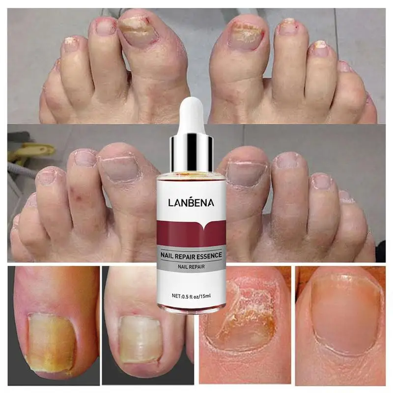 Крем для удаления ногтя. LANBENA Nail Repair Essence от грибка ногтей. Средство от грибка ногтей LANBENA Nail Repair Essence 15 ml. Сыворотка эссенция LANBENA. LANBENA эссенция для ногтей.