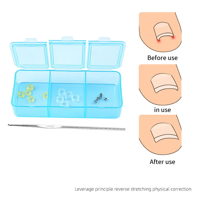 1 комплект корректор для вросших ногтей педикюр восстановление лечение на ногах