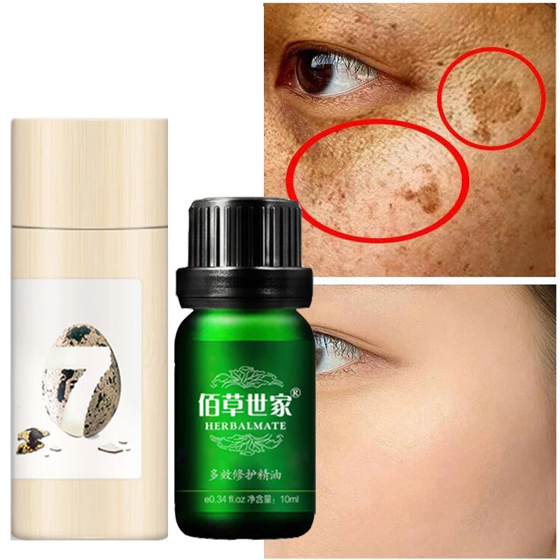 Freckle Whitening Serum Curcumin Oil Brighten Fade Dark Spot Removal Pigment Melanin Correcting Beauty Face Skin Care