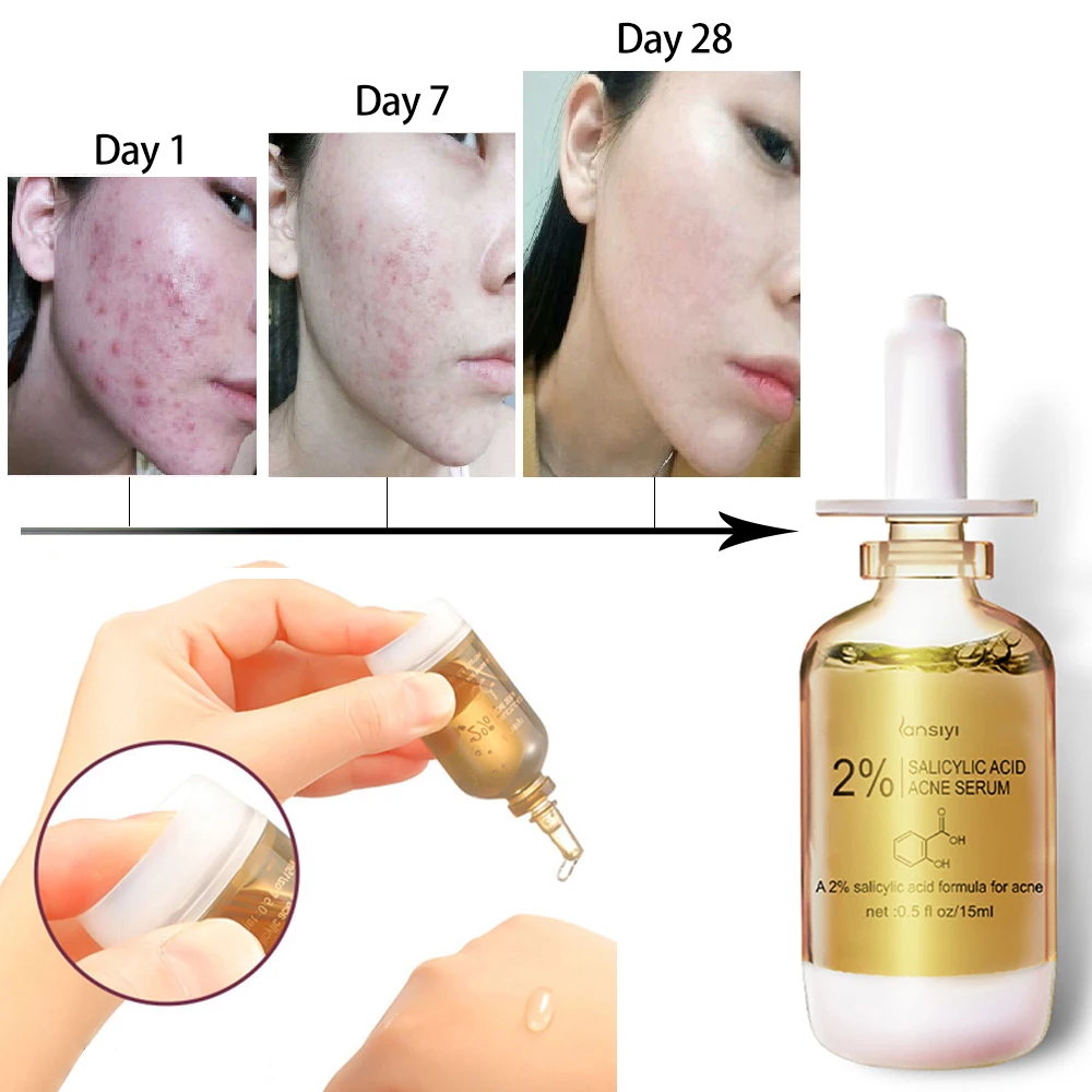 

Салициловая кислота 2%, сыворотка профессионального класса для лечения акне, гиперпигментации и преждевременного старения, стеклянная пипетка для мужчин и женщин, сыворотка для лица