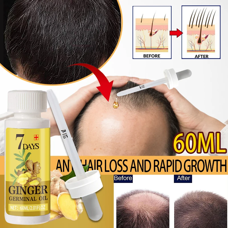 

7-day Ginger Hair Growth Care: Fast Growing Hair Essential Oil, Beauty Care, Hair Loss Prevention, Oily Scalp Treatment,