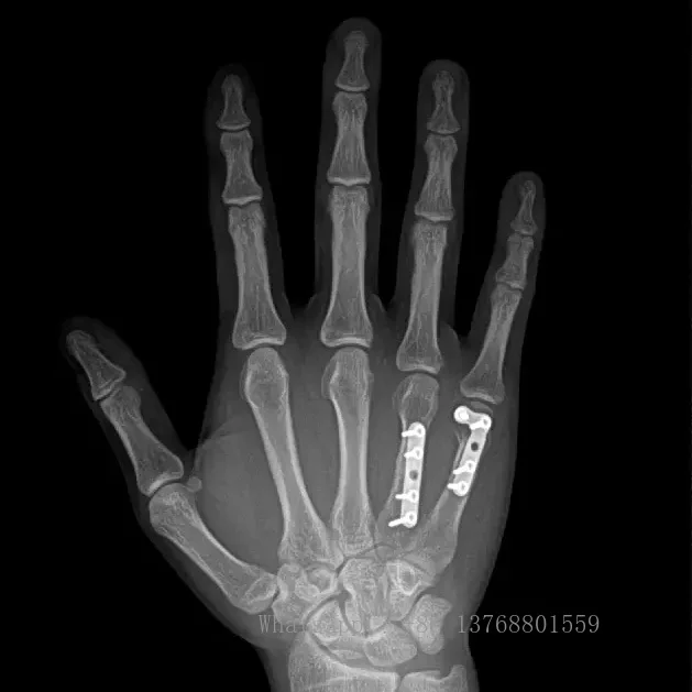 Поддержка класса программного обеспечения 14*17 Беспроводная DR-радиография Xray 14x17
