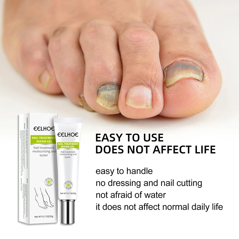 

Сыворотка для ногтей от грибков, восстанавливающая сыворотка для ногтей, гель для удаления грибка ногтей, Лечение ногтей против инфекции паронихии и онихомикоза