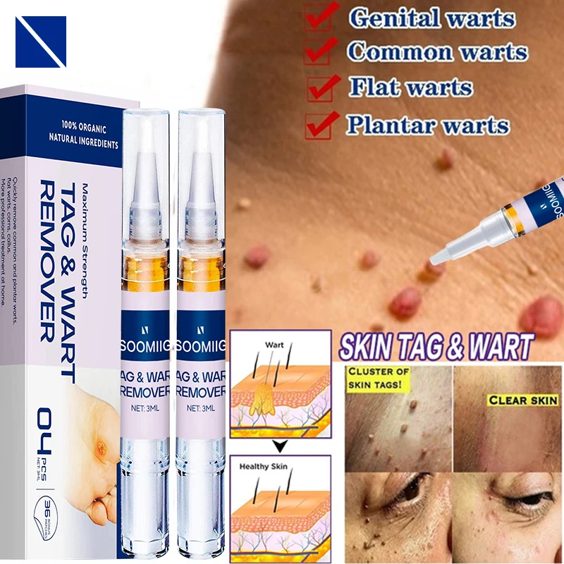 

Soomiig Wart Removal Mole Remedy Liquid Pen Painless Beauty Herbal Cream Treatment Papilloma Removal Skin Tags Flat Wart Genital