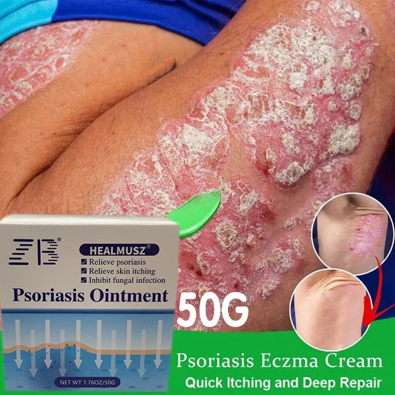 

Крем при псориазе 50 г, Eczematoid, восстанавливающий кожу, Женская уход, повязка, ортопедическая терапия, мазь