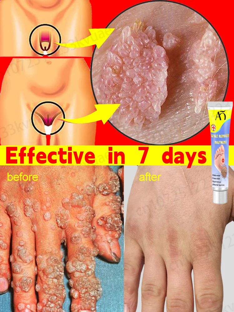 

Средство для удаления бородавок, бородавок