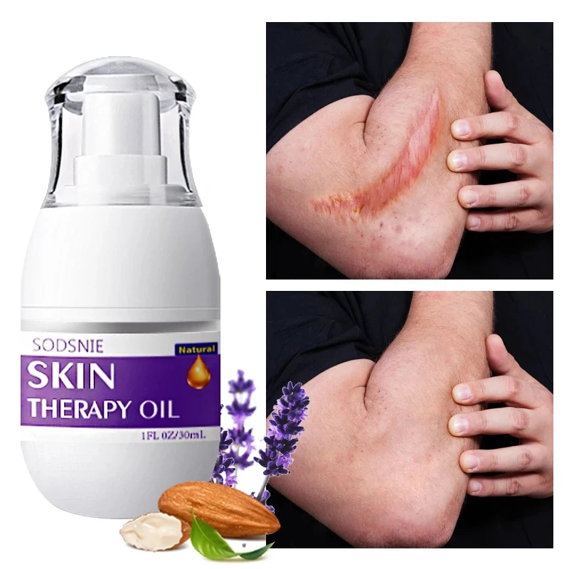 

Natural Skin Therapy Oil Eliminates Stretch Marks Scars Repairs Aging Damaged Skin Whitening Moisturizing Cream Body Skin Care