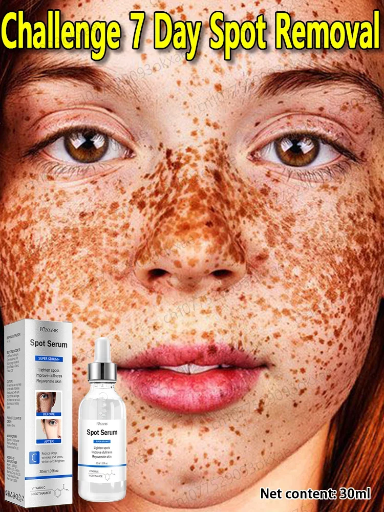 

Quickly Freckle Removal Improve Freckle Dark Spots Sun Melasma Remove Age Spots Lightening Melanin Whitening Facial Skin Care