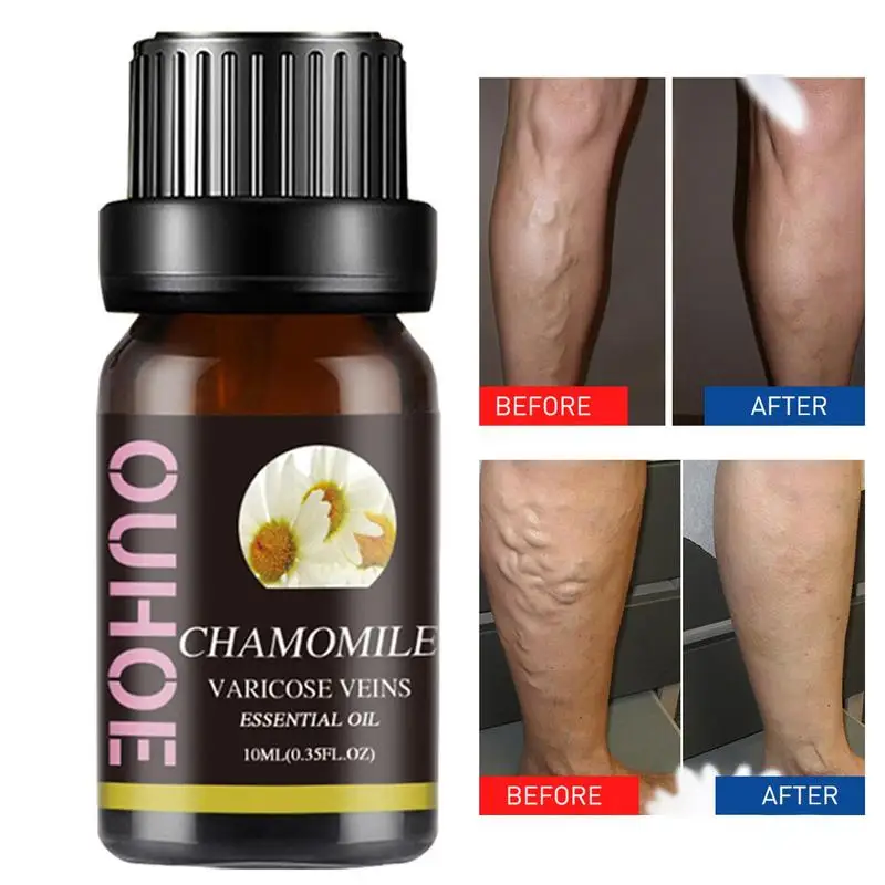 

Chamomile Essential Oil 10ml For Legs Effectively Relieve Essential Oils For Body Massage Oil Body Oils For Women