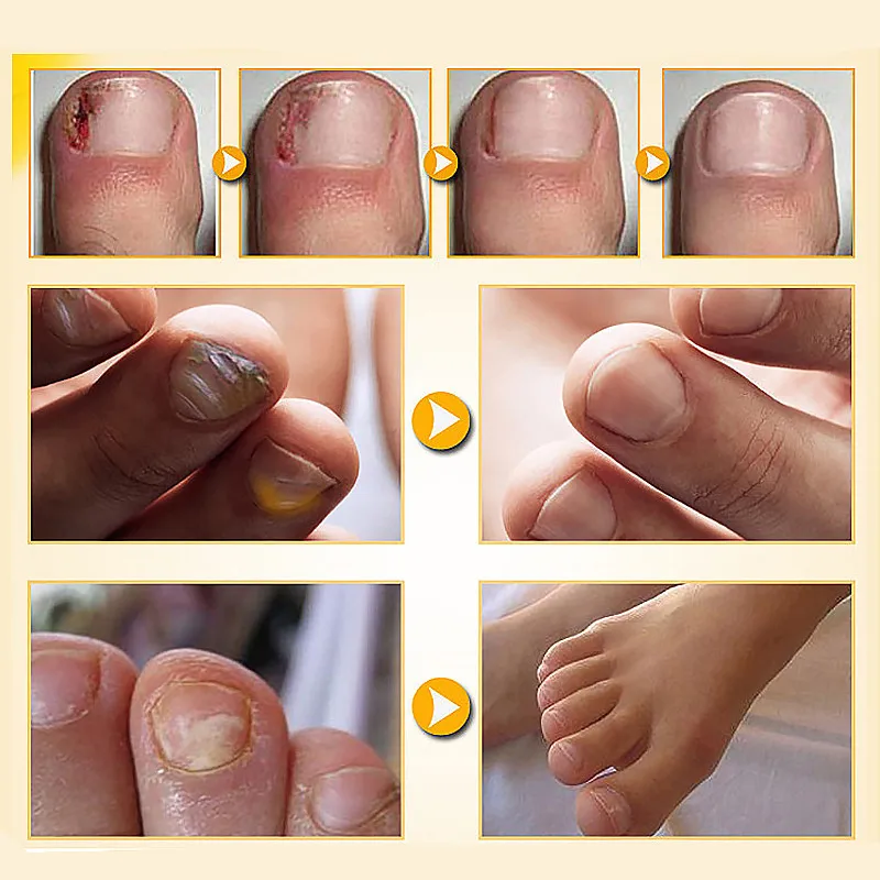 Антигрибковая Сыворотка для ногтей лечение онихомикоза восстановление