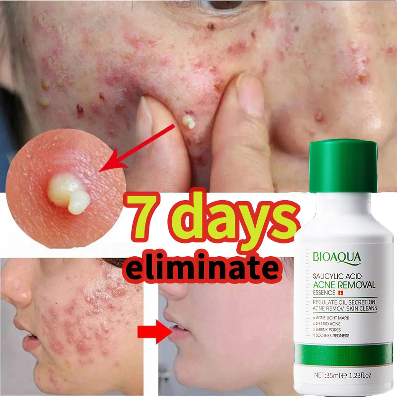 Salicylic Acid Acne Removal Serum Remove Pimple Scar Spots Treatment Shrink Pores Oil Control Whitening Moisturizing Skin Care