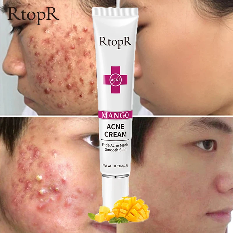 RtopR Acne Face Cream Anti-Acne Gel Remove Blackhead Treatment Acne Scar Oil Control Eliminate Pimples Whitening Skin Care 15g