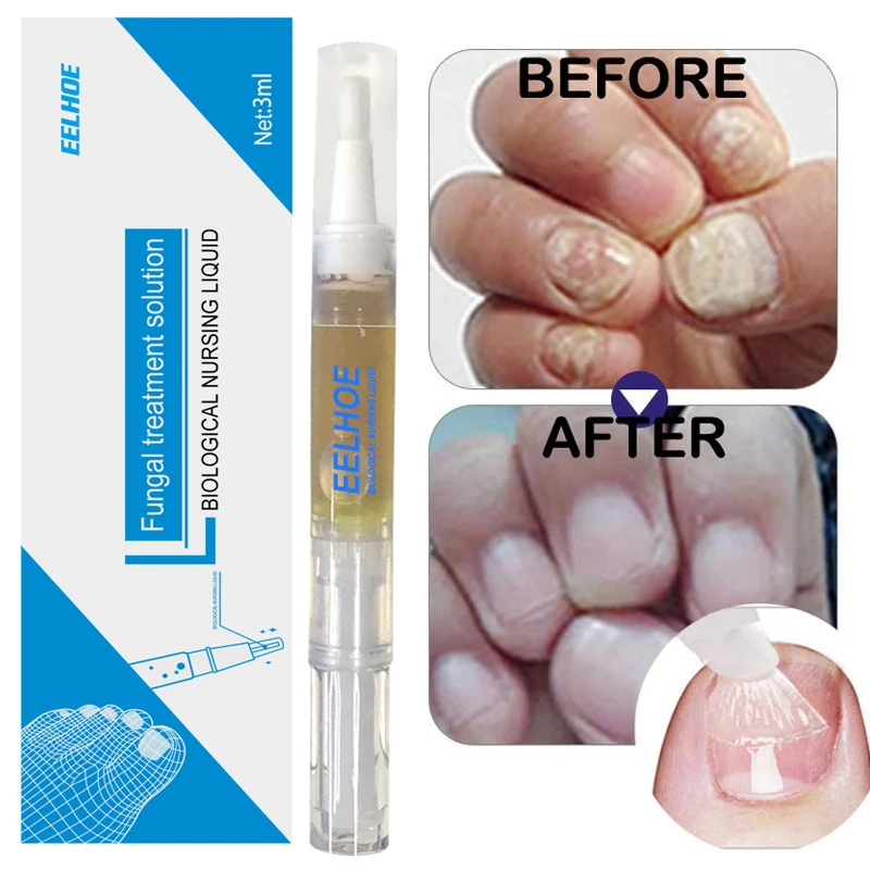 

Fungal Nail Treatment Pen Onychomycosis Paronychia Anti-Fungal Serum Nail Infection Toe Fungus Foot Repair Essence Care