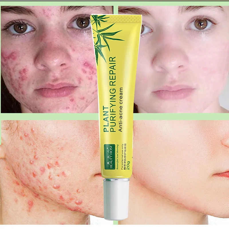 

Effective Acne Removal Cream Anti-Acne Treatment Acne Scar Spots Oil Control Shrink Pores Moisturizing Whitening Face Gel Care