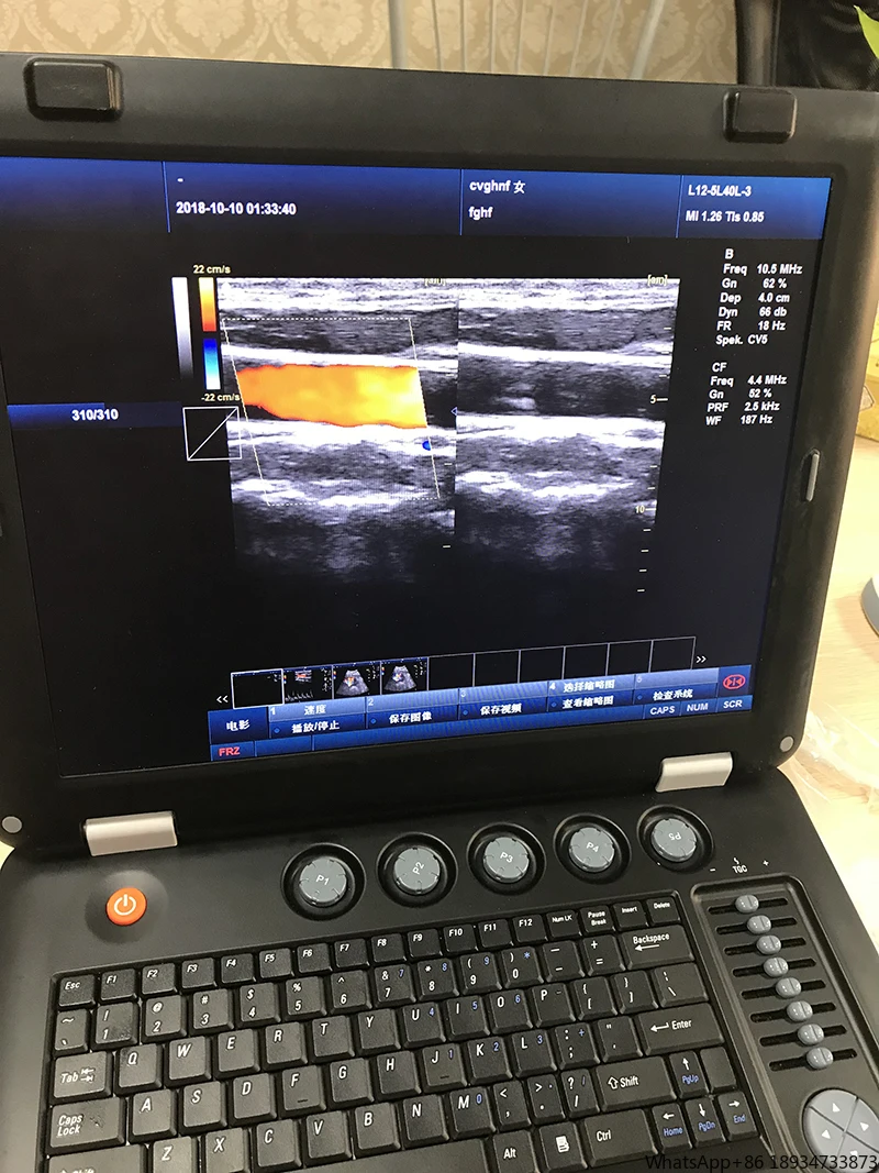 Sunbright Hospital Color Doppler Ecografo Портативный портативный ультразвуковой ультразвук для