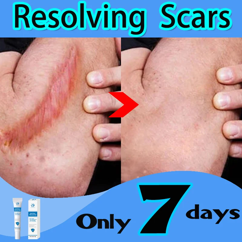 

scar cream facial scar whitening cream Acne Spots Acne Treatment scar gel Treating Stretch Mark Burns Surgical Scar Repair Cream