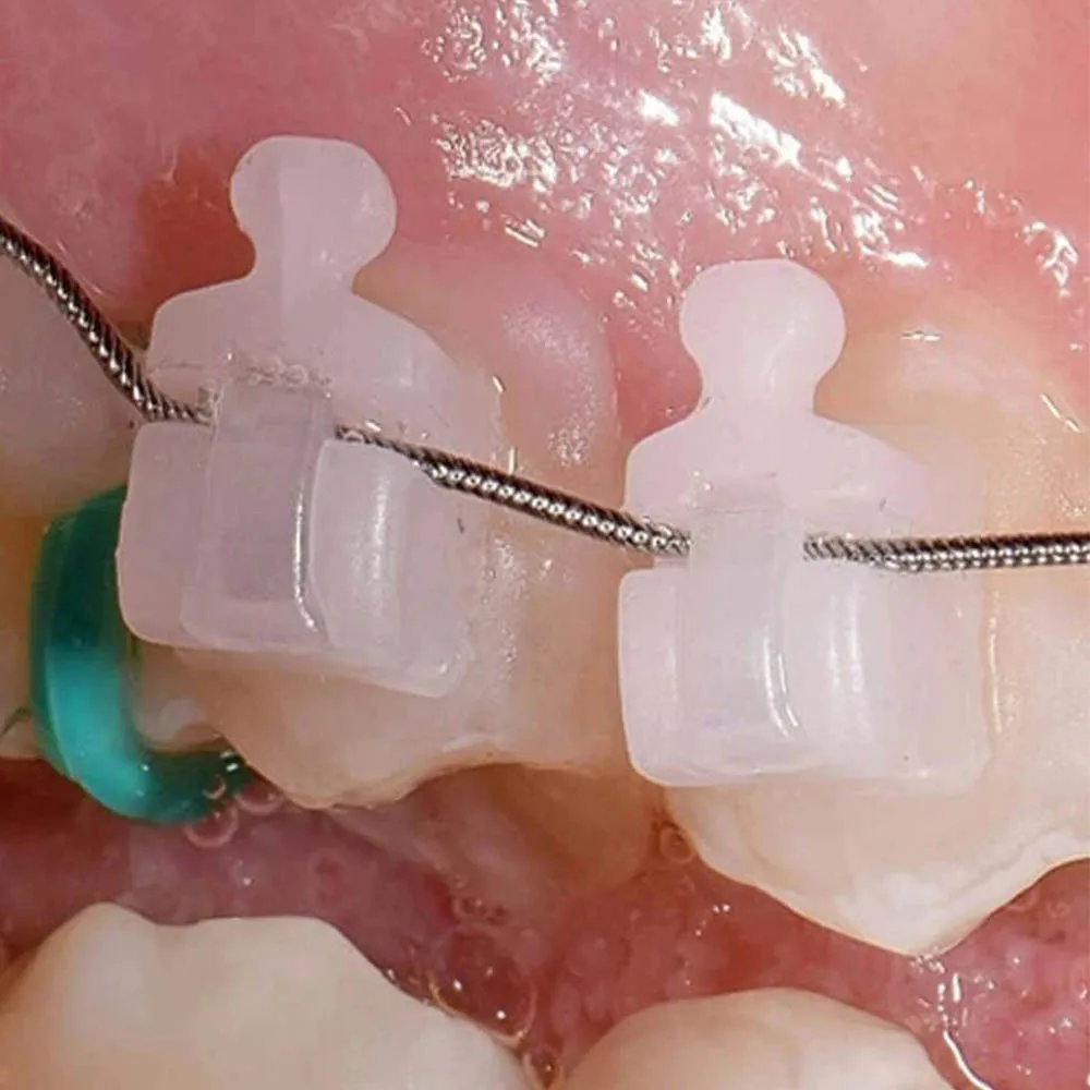 stomatologiczna 20 sztuk/zestaw samoligaturująca rurka wspornik ortodontyczny ceramiczny 345 hak całkowicie Roth/MBT 022 narzędzie stomatologiczne