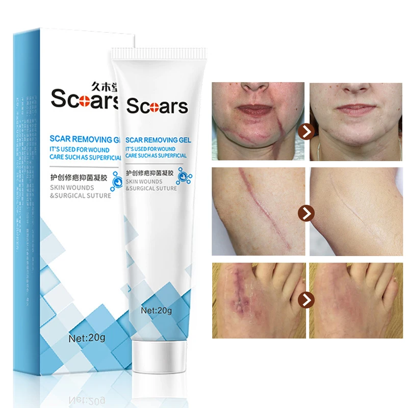 

Крем травяной для удаления шрамов, средство для удаления растяжек, от акне и пятен, хирургическое средство для удаления старого шрама, средс...