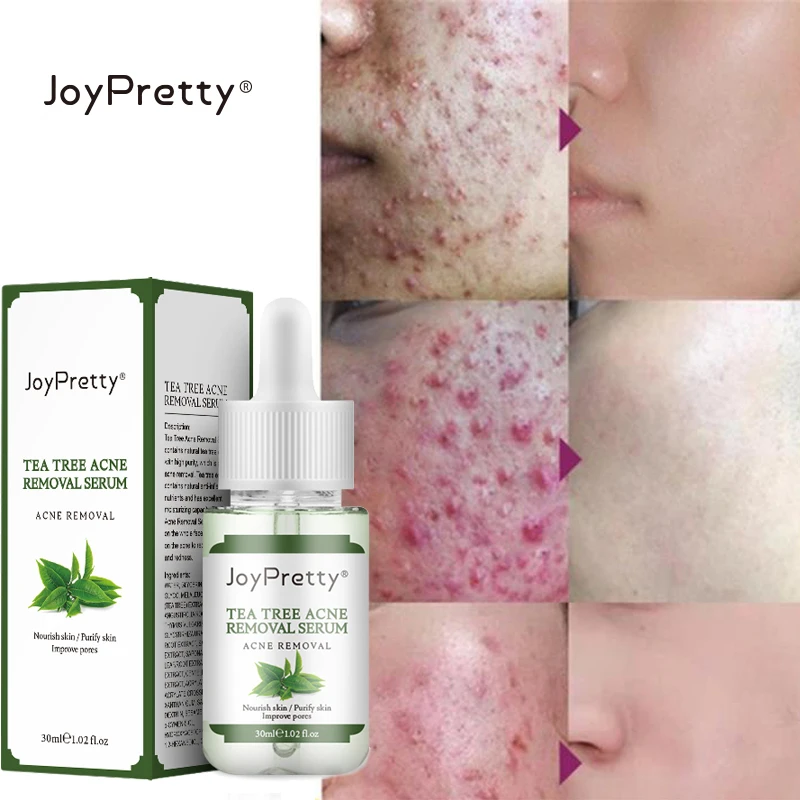 

Эффективная Сыворотка для удаления прыщей, эссенция для лечения прыщей, крем для сужения пор, контроль жирности, отбеливание, увлажнение, ух...