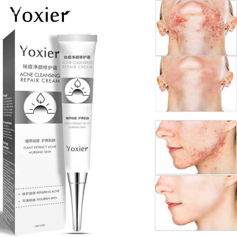 

Yoxier Acne Treatment Cream Remove Blackhead Pimple Shrink Pores Fade Acne Marks Antibacterial Oil Control Whitening Skin Care