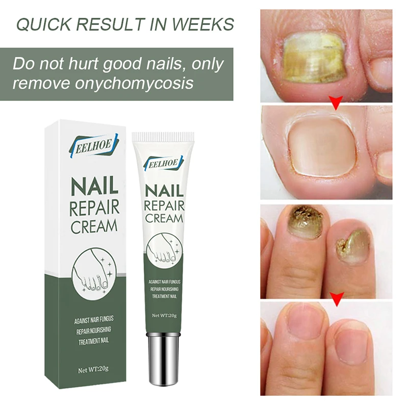 

20g Nail Antibacterial Cream Thicken Nails Inhibit Fungus Onychomycosis Hand Foot Nail Care Treatments Plaster Health Care Cream