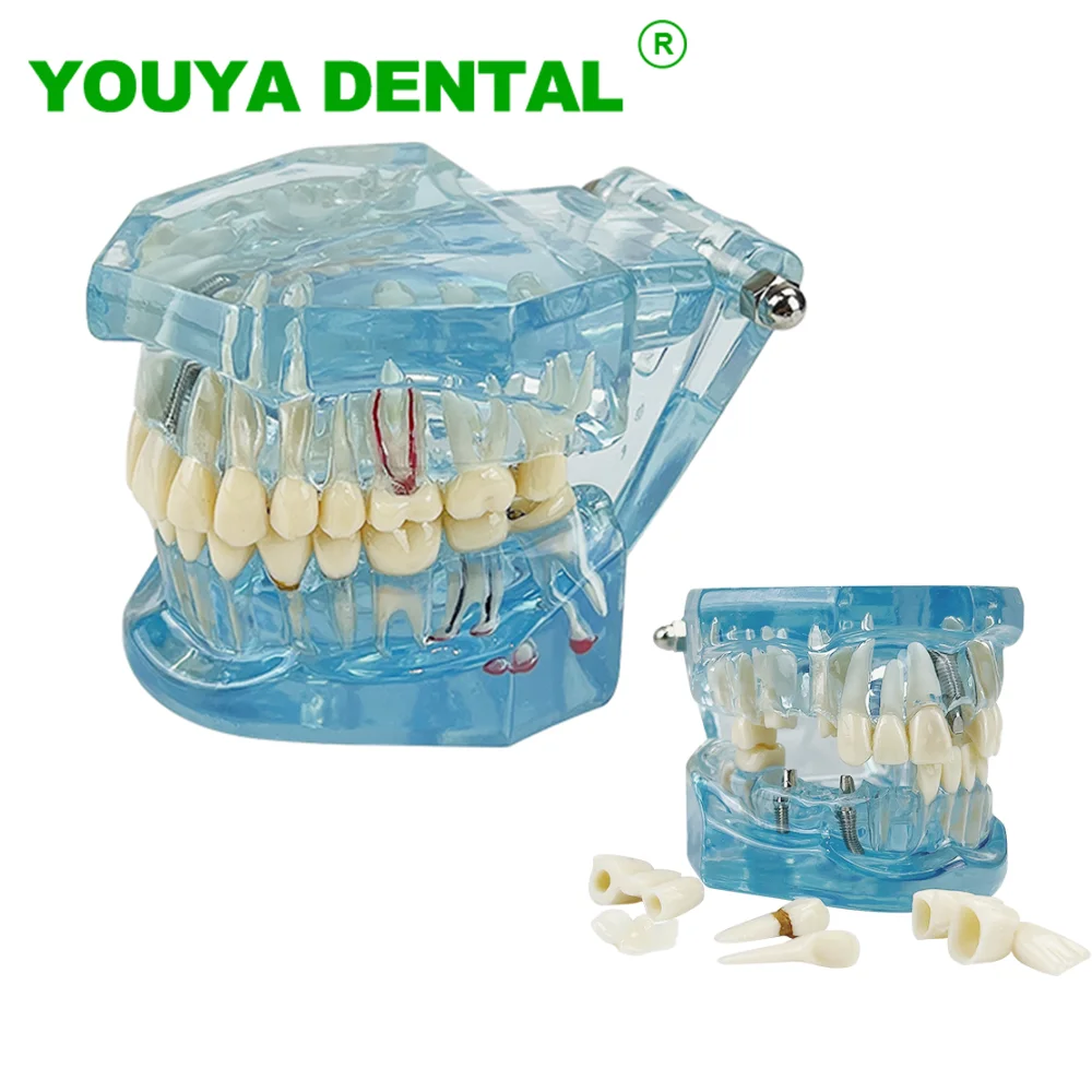 

Dental Model Teeth Implant Restoration Bridge Tooth Dentist Medical Science Dentistry Disease Teaching Study Demonstration Model