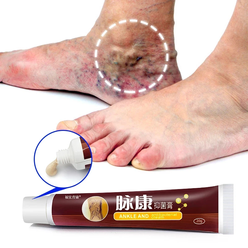 

1pcs Varicose Veins Relief Cream Leg Vasculitis Phlebitis Spider Shape Vein Pain Ointment Chinese Herbal Medical Plaster 10/20g