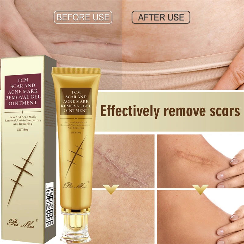 

Acne Scar Removal Cream Stretch Marks Treatment Pimples Spots Repair Gel Whitening Moisturizer Smooth Beauty Skin Care Product