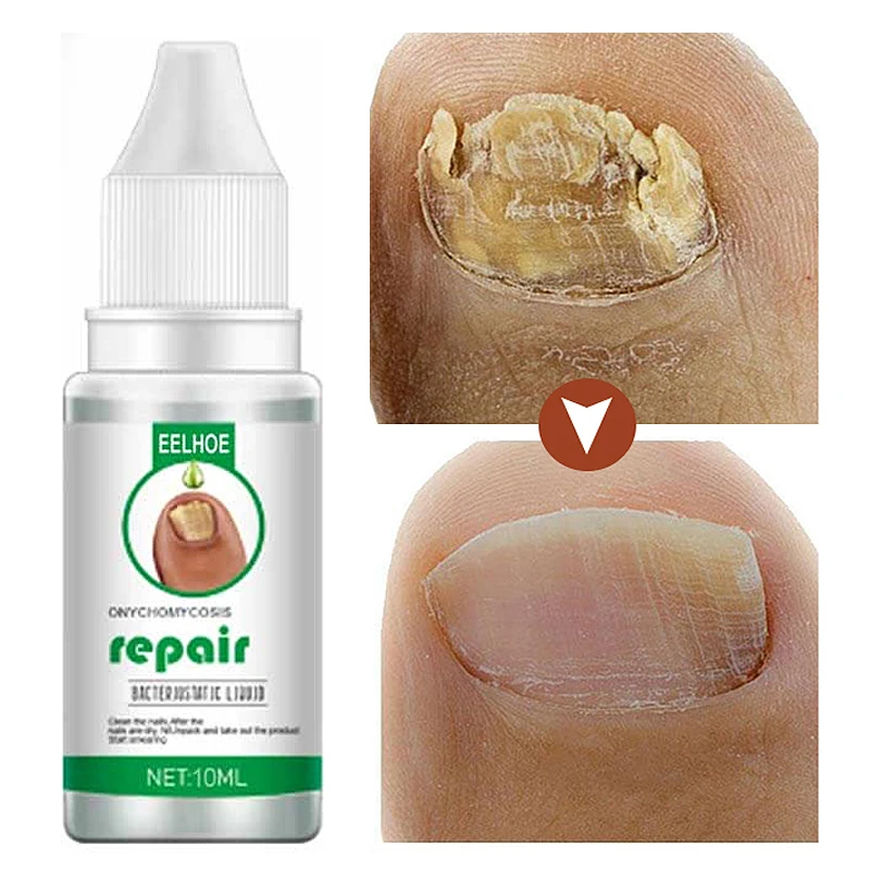 

30ml Nail Fungus Treatment Essence Feet Care Toe Foot Anti Fungal Infection Serum Paronychia Onychomycosis Removes Gel Product