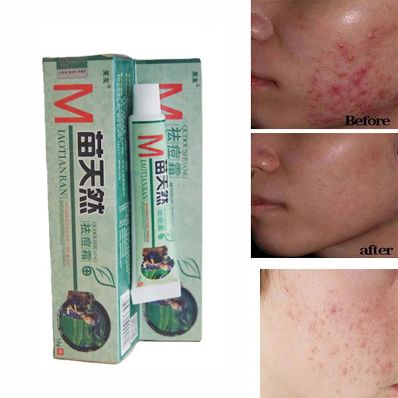 

1Pc Natural Germicidal Removel Cream Mite Moisturize Skin Cream Original Remove Acne Ointment 18g