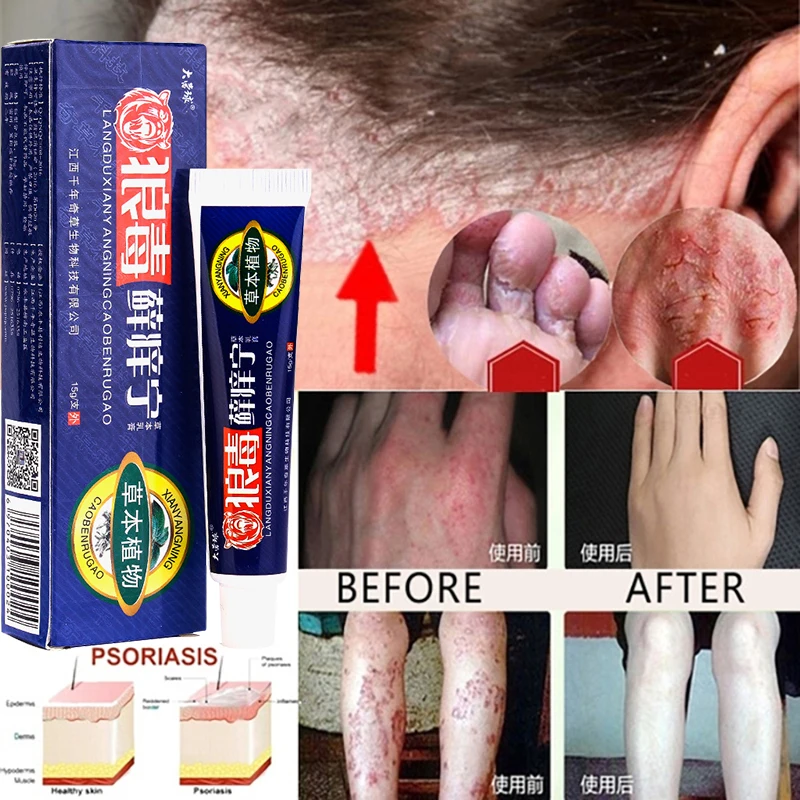 

Dropshipping Skin Psoriasis Cream Dermatitis Eczematoid Eczema Ointment Treatment Psoriasis Skin Care Cream
