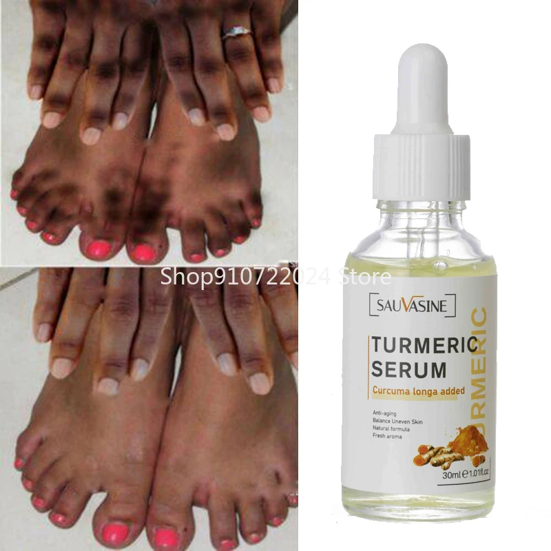 

30ml Turmeric Lemon Oil Skin Glow To Lightening Acne Dark Patches, Acne Bright Skin Dark Spot Corrector Face Whitening Serum