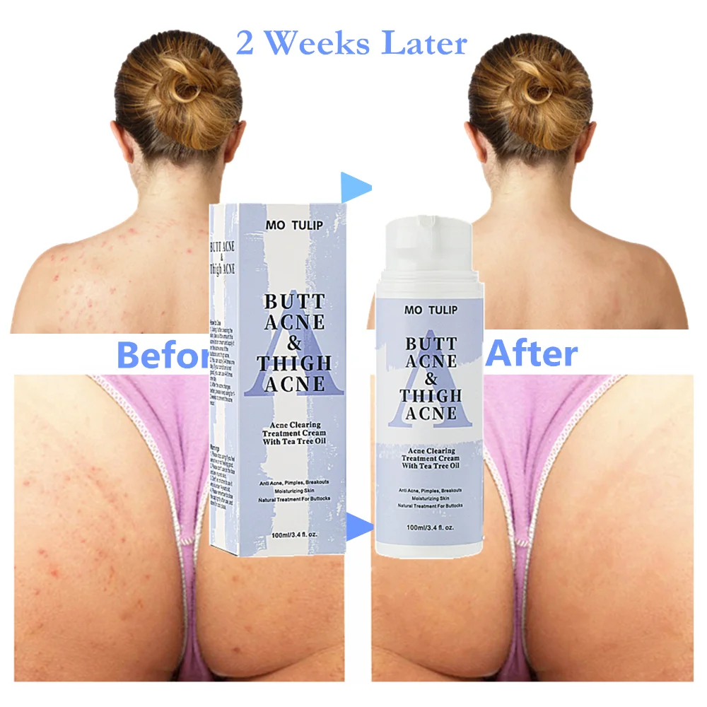 

100ml Butt Acne Clearing Spot Treatment Cream Clears Acne Pimples Zits Razor Bumps and Dark Spots for the Buttocks Thigh Area