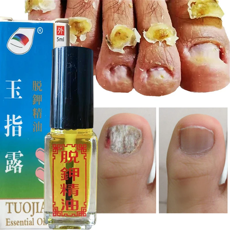 

Fungal Nails Treatment Serum Toenail Fungus Remover Essence Anti Infection Repair Paronychia Onychomycosis Hand Foot Health Care