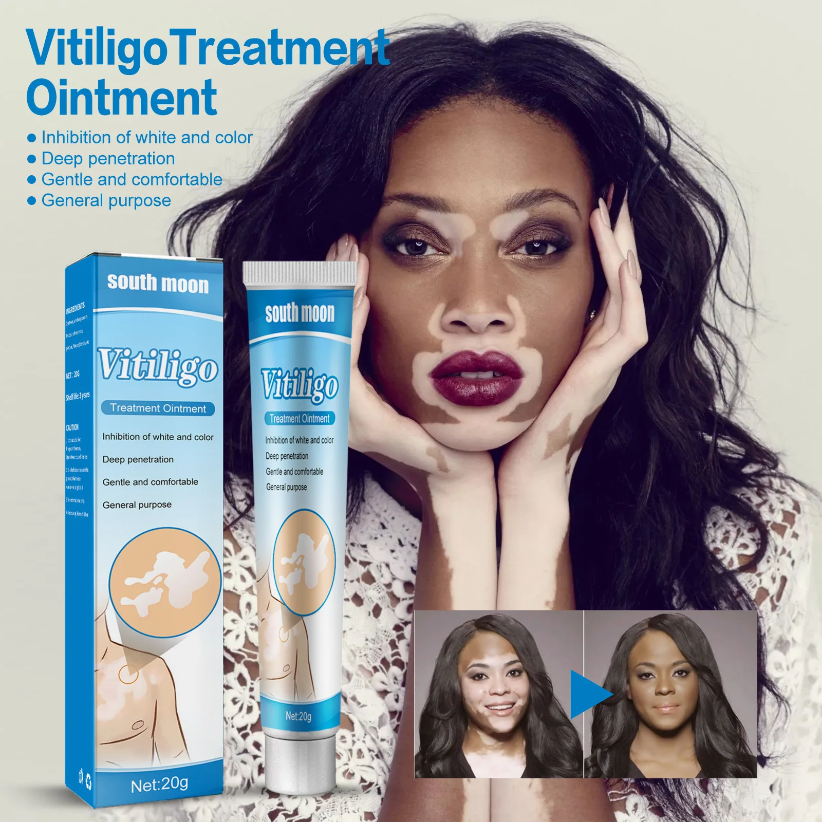 

Herbal Extract White Spot Disease Cream Vitiligo Ointment Remove Ringworm Treament Repair Leukoplakia Reduce Pigment Skin Care