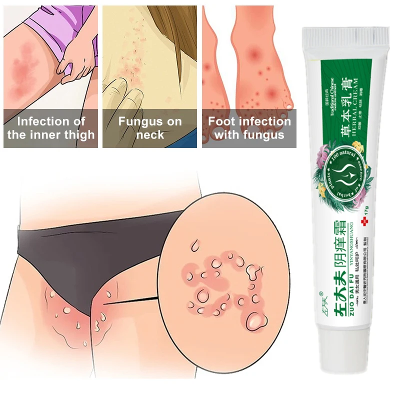 5 pcs Herbal Antibacterial Cream Private Part Care Anti-itch genital itching Skin Care Remove Odor Pruritus Fungus Anti-itching