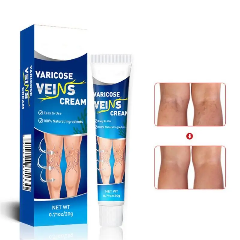 

Ointment For Varicose Veins Eliminate Spider Legs Spider Vein To Relieve Vasculitis Phlebitis Spider Pain Treatments Varicose
