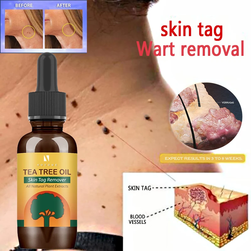 

Wart Removal Mole Remedy Liquid Essential Oil Treatment Papilloma Removal Skin Tag Flat Warts Genital Painless Beauty Herbs