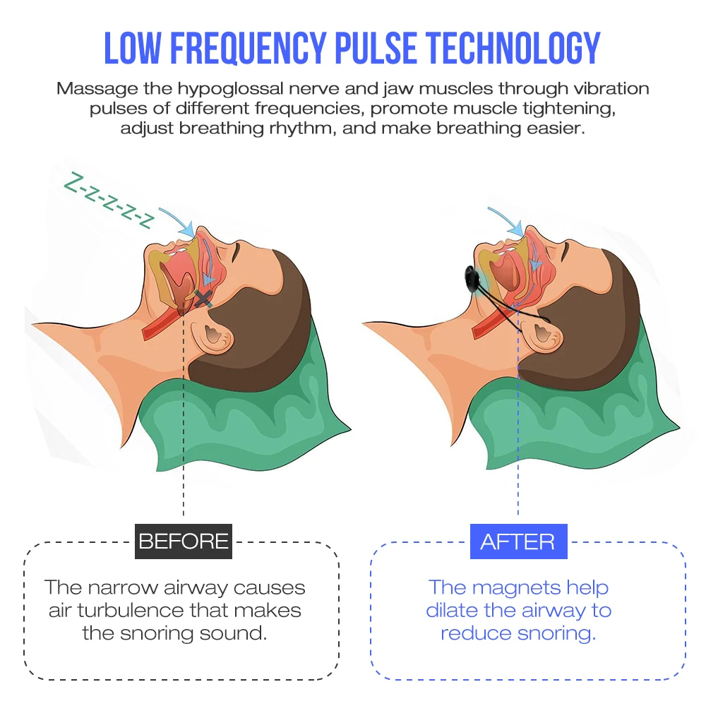 Умное устройство для защиты от храпа храп туффи нос Интеллектуальный