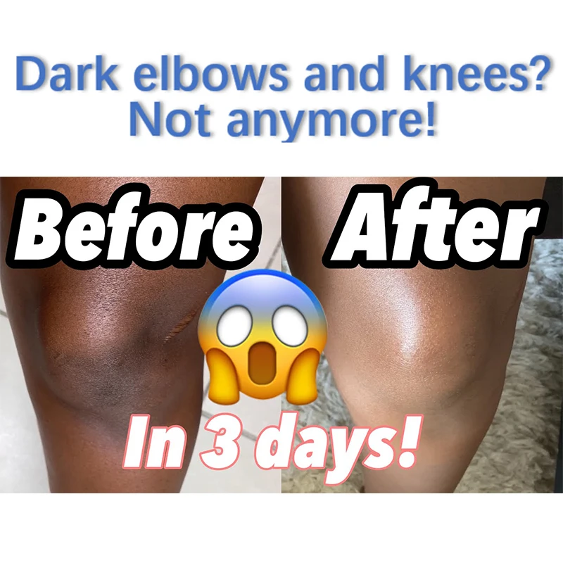 

Brown Sugar Goat Milk Exfoliating Gel Lighten Dark Elbows Knuckles Knees Remove Hyperpigmentation Gain Even Brighter Complexion
