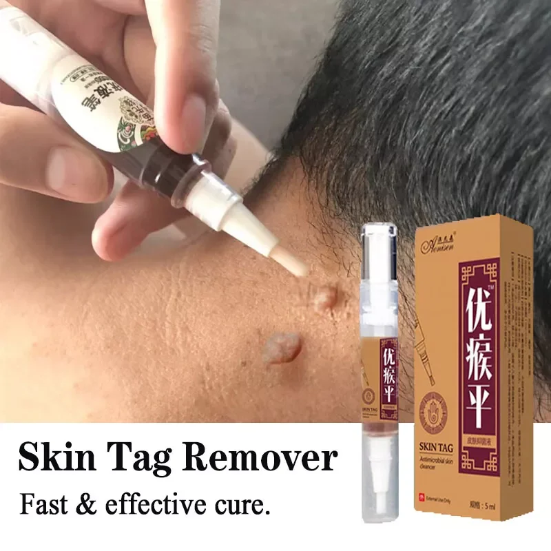 New in Tag Remover  Against Mole & Genital Wart fast RemovWithin al Anti Foot Corn Removal Warts Papillomas Rapidly removes