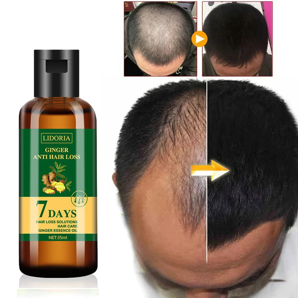 

35 мл Эфирное масло для роста волос имбиря Натуральные продукты против выпадения волос Предотвращение облысения Уход за волосами Остановить выпадение волос