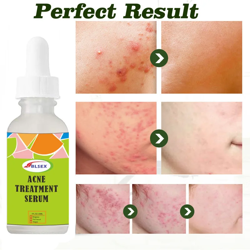 

Acne Removal Serum Salicylic Acid Anti-Acne Repair Fade Acne Spots Pimple Oil Control Cream Retinol Whitening Moisturizing Care