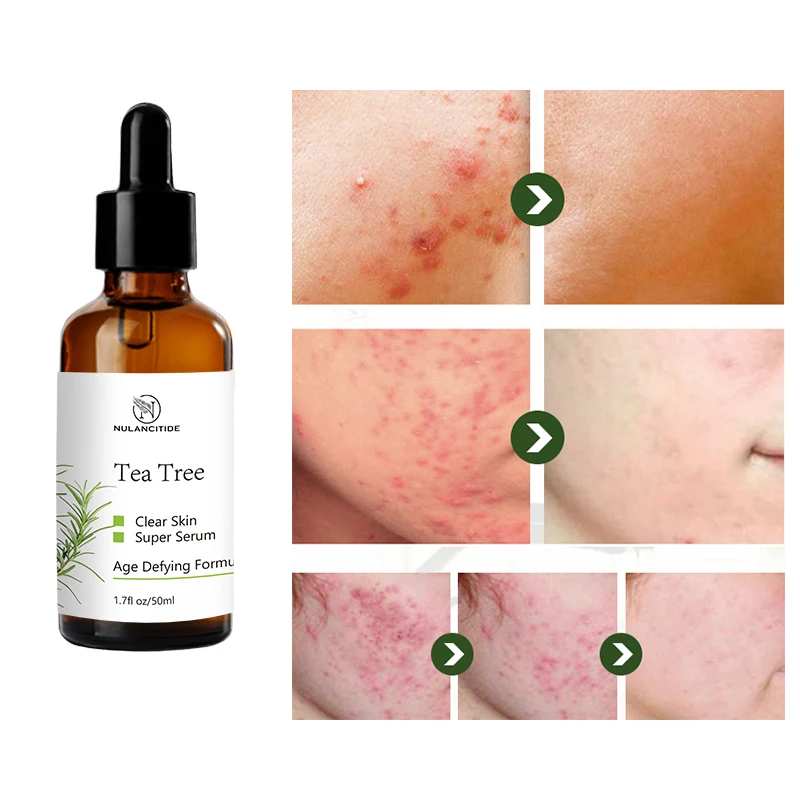 

Tea Tree Acne Treatment Face Serum Anti Acne Whelk Oil Control Shrink Pores Essence Moisturizing Whitening Repair Pimple Scar