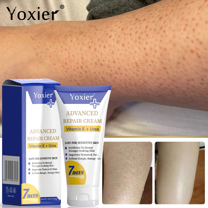 

Vitamin E Repair Cream Moisturizing Improves Dry Rough Bulging Skin Treatment Keratosis Pilaris Smoothes Softens Skin Care 50g