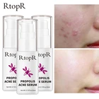 RtopR акне осветляющая эссенция акне шрам увлажняющий Восстанавливающий сыворотка устранение усадки лечение акне прополис контроль масла 3 ps