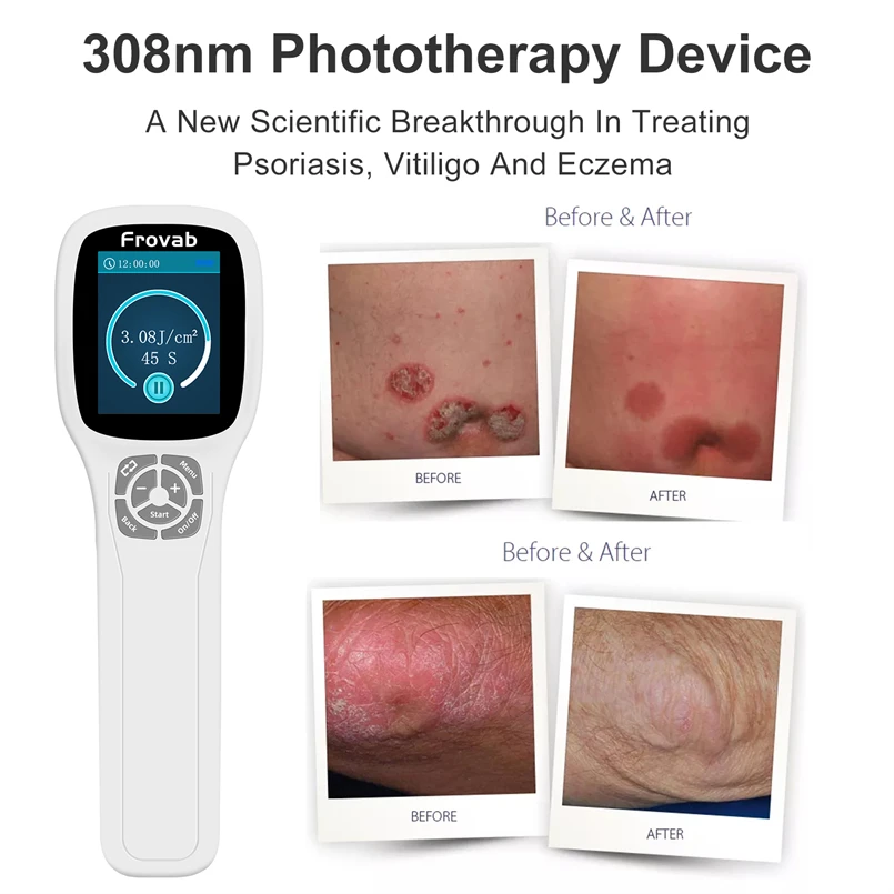 Медицинское устройство для лечения пятен экземы Нм